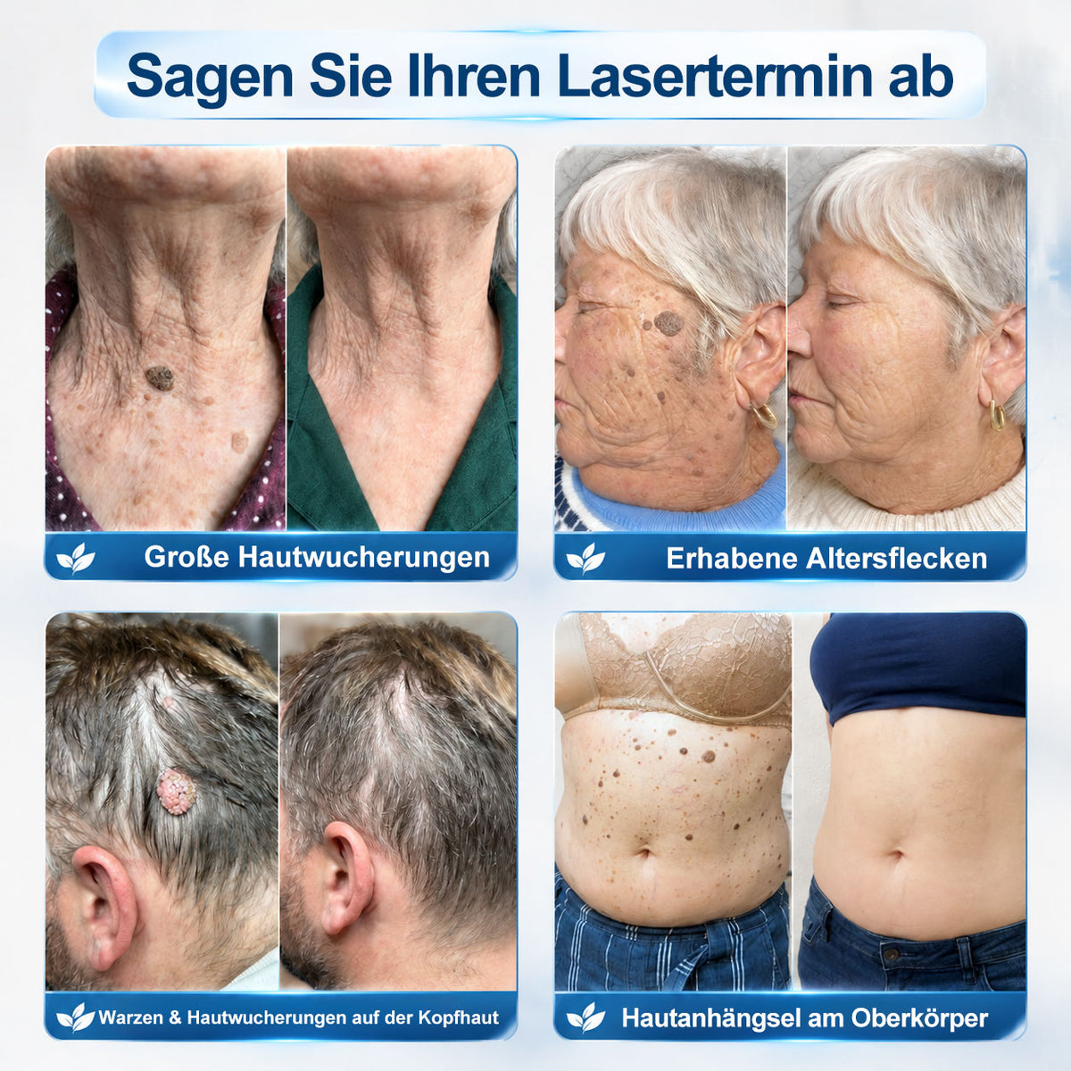 Offizieller Markenstore |✅𝑷𝑖𝒄𝐝𝐨® 7-𝑻𝒂𝒈𝒆 𝑯𝒂𝒖𝒕𝒂𝒏𝒉ä𝒏𝒈𝒔𝒆𝒍- & 𝑭𝒍𝒆𝒄𝒌𝒆𝒏𝒆𝒏𝒕𝒇𝒆𝒓𝒏𝒆𝒓(Schmerzfreier Rollerball – Keine Narbenbildung)🛡️