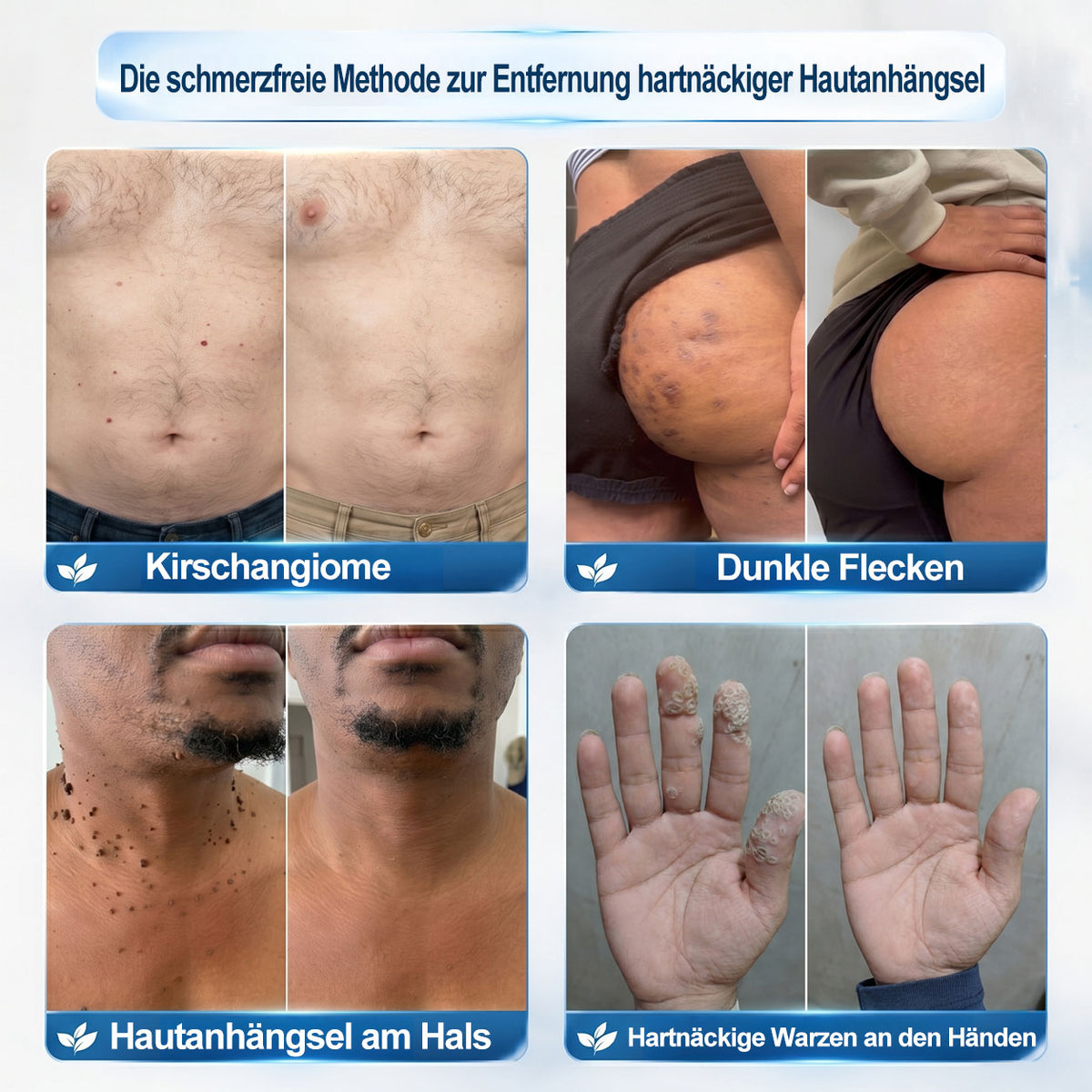 Offizieller Markenstore |✅𝑷𝑖𝒄𝐝𝐨® 7-𝑻𝒂𝒈𝒆 𝑯𝒂𝒖𝒕𝒂𝒏𝒉ä𝒏𝒈𝒔𝒆𝒍- & 𝑭𝒍𝒆𝒄𝒌𝒆𝒏𝒆𝒏𝒕𝒇𝒆𝒓𝒏𝒆𝒓(Schmerzfreier Rollerball – Keine Narbenbildung)🛡️